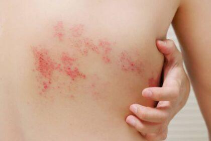 ds herpes