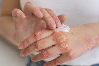 ds psoriasis