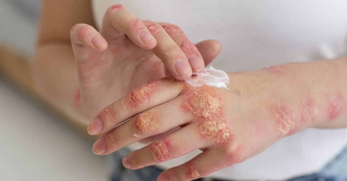 ds psoriasis