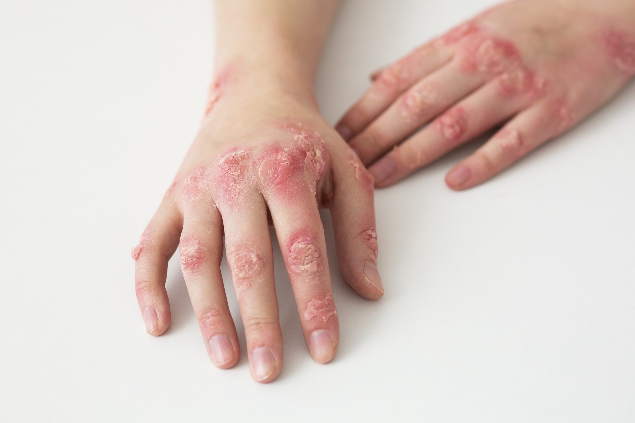 u psoriasis scaled